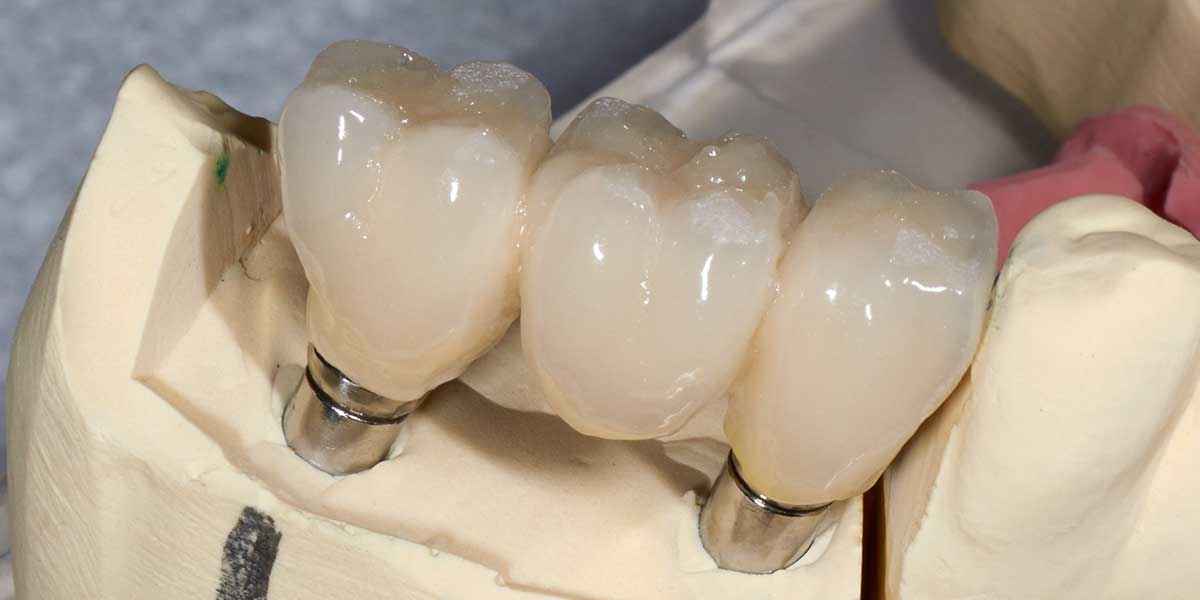 Dental Implant Supported Bridges in Forty Fort