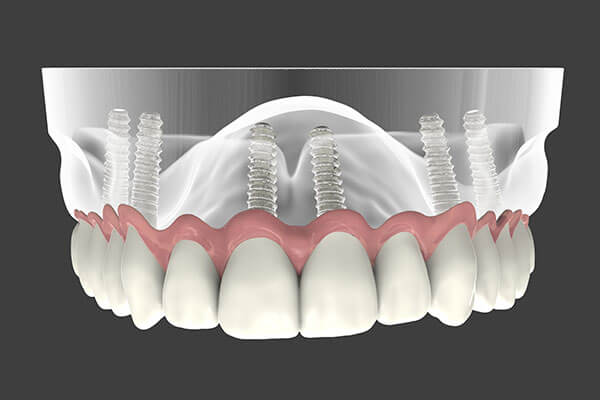 Implant Supported Denture in Forty Fort