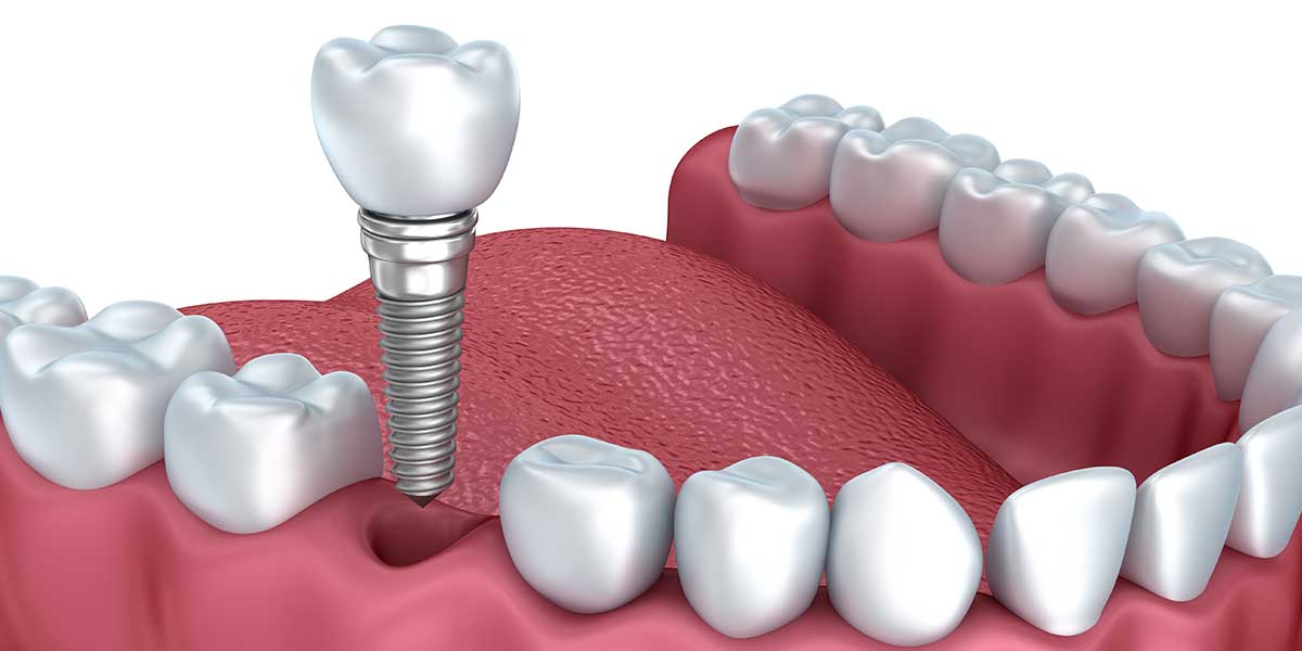 Single Dental Implants in Forty Fort