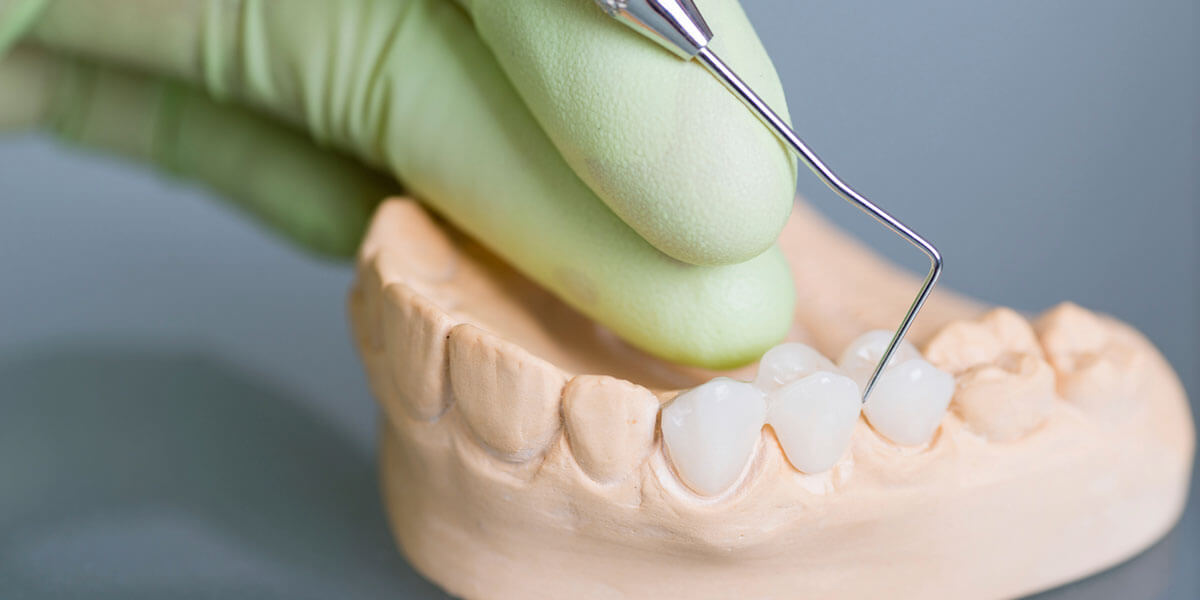 Porcelain Dental Bridge on Clay Model