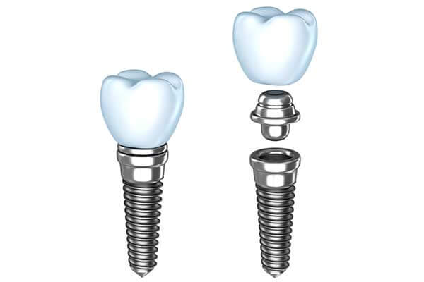 Single Dental implants in Forty Fort, PA