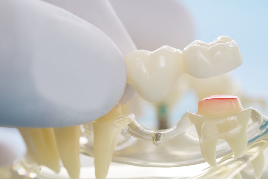 How Long Do Dental Bridges Last? | Forty Fort, PA