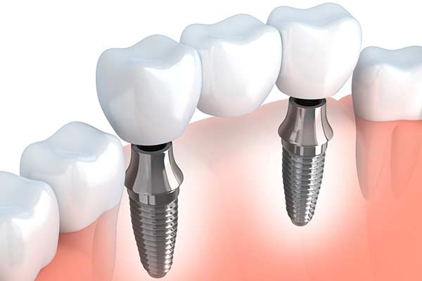 Implant Supported Bridges in Forty Fort