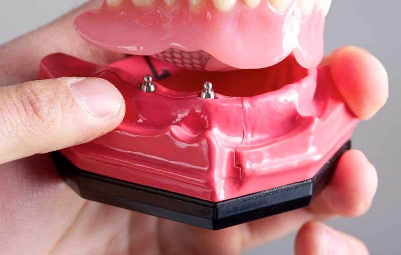 Mini Dental Implants in Forty Fort