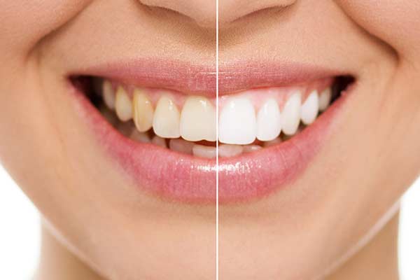 Before & After Teeth Whitening in Forty Fort