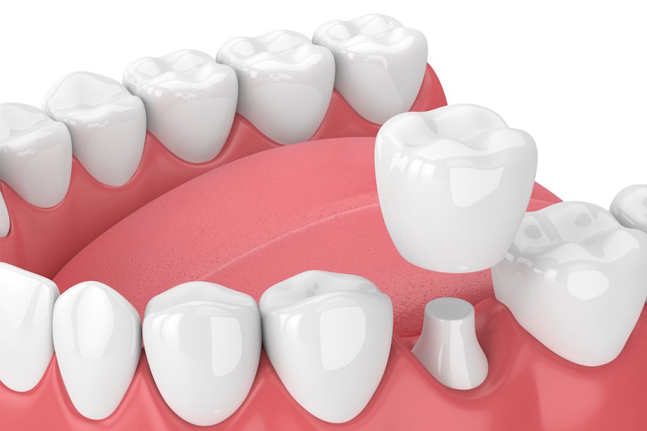 Zirconia vs. Porcelain Crowns | Best Option for Your Smile